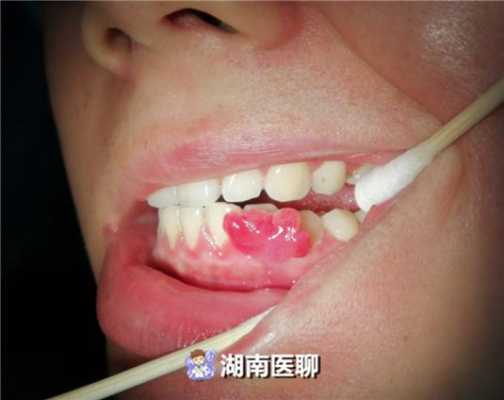 孕期牙龈出血严重怎么办(孕妇牙龈出血会影响胎儿吗) 第3张 孕期牙龈出血严重怎么办(孕妇牙龈出血会影响胎儿吗) 第3张