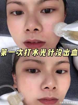 备孕期可以打水光针吗（备孕期可以打水光针吗女性）  第2张