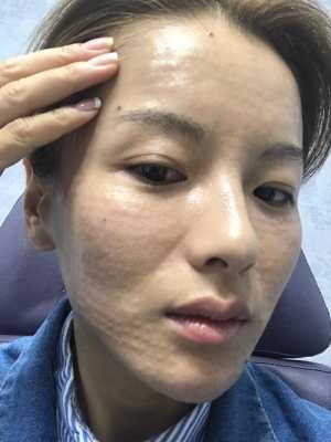 备孕期可以打水光针吗（备孕期可以打水光针吗女性）  第3张