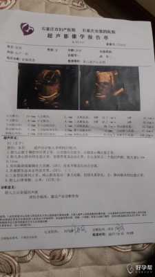 怀孕33周，还能做胎儿心脏彩超吗,胎儿心脏彩超挂什么科预约检查  第2张