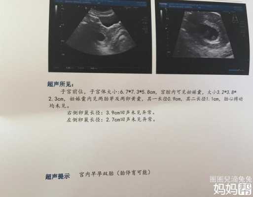 胎儿为什么会没有胎心(胎儿为什么会没有胎心胎芽) 第2张 胎儿为什么会没有胎心(胎儿为什么会没有胎心胎芽) 第2张