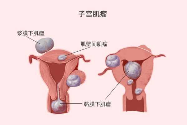 子宫肌瘤对胎儿的影响（子宫肌瘤对胎儿的影响大吗）  第2张