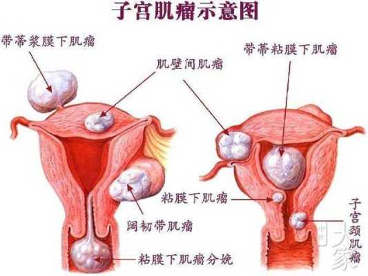 子宫肌瘤影响胎儿发育吗(子宫肌瘤能生孩子吗) 第2张 子宫肌瘤影响胎儿发育吗(子宫肌瘤能生孩子吗) 第2张