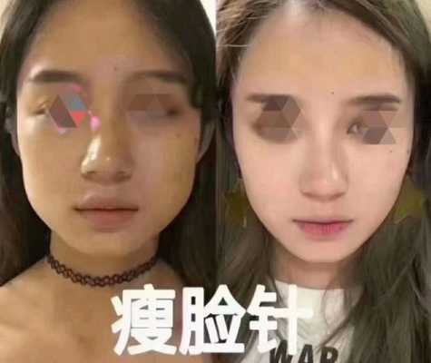 怀孕期间可以打瘦脸针吗(请问备孕期间可以打瘦脸针吗?有什么需要注意的呢) 第2张 怀孕期间可以打瘦脸针吗(请问备孕期间可以打瘦脸针吗?有什么需要注意的呢) 第2张