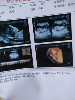 怀孕19周胎儿彩超(怀孕19周胎儿彩超) 第1张 怀孕19周胎儿彩超(怀孕19周胎儿彩超) 第1张