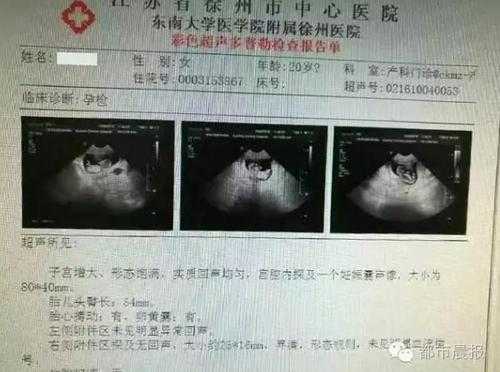 产检b超看什么,孕期b族链球菌是查什么的 第2张 产检b超看什么,孕期b族链球菌是查什么的 第2张