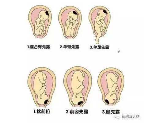 左骶前位胎儿图片（胎位左骶前是什么位置）  第3张