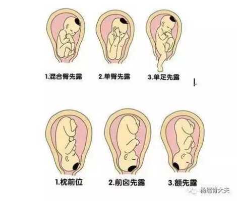 左骶前位胎儿图片(胎位左骶前是什么位置) 第3张 左骶前位胎儿图片(胎位左骶前是什么位置) 第3张