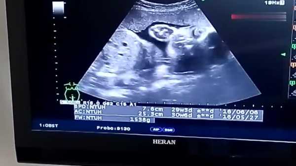 怀孕30周的胎儿图片（我的宝宝30周B超显示腿偏短怎么办）  第1张