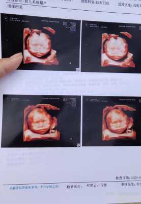 四维彩超兔唇怎么办,胎儿唇腭裂四维图片大全 第1张 四维彩超兔唇怎么办,胎儿唇腭裂四维图片大全 第1张