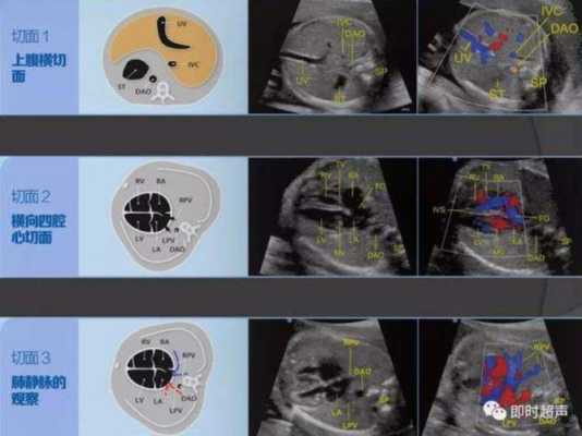 胎儿心脏有两个点是怎么回事,胎儿超声心动图是什么检查  第2张