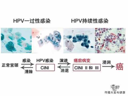 孕妇得了支原体感染应该怎么办,孕期感染hpv会传染给胎儿吗  第2张