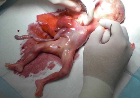 四个月引产的胎儿图片（四个月怀孕引产下来的婴儿形状能分辨出男女吗）  第3张