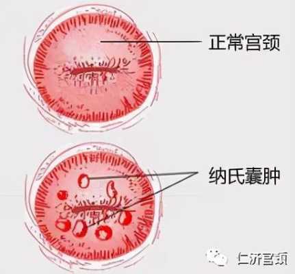 怀孕了子宫里面有囊肿如何是好,孕期囊肿是什么原因引起的  第1张