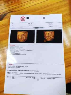 孕妇二维彩超检查什么啊?不知道一般情况下检查哪些方面,孕期彩超做的频繁对胎儿有影响吗 第1张 孕妇二维彩超检查什么啊?不知道一般情况下检查哪些方面,孕期彩超做的频繁对胎儿有影响吗 第1张