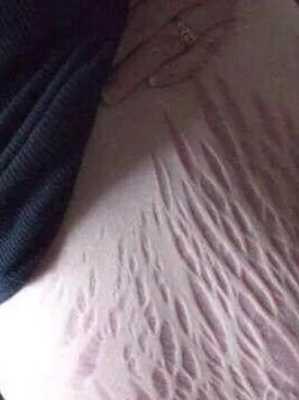孕期妊娠纹（孕妇肚子有妊娠纹怎么回事）  第3张