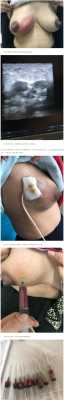 孕期乳腺（孕期乳腺脓肿怎么办）  第2张