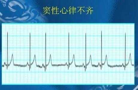 胎儿窦性心律什么意思(胎儿窦性心律什么意思1:1是什么意思) 第2张 胎儿窦性心律什么意思(胎儿窦性心律什么意思1:1是什么意思) 第2张