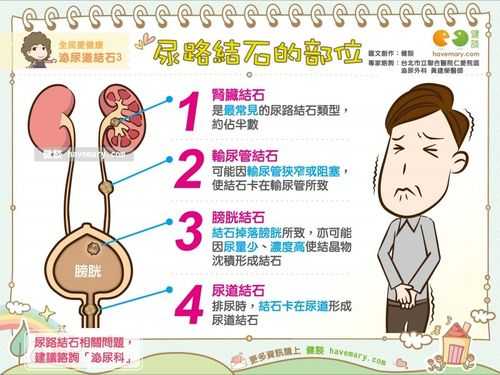 孕期结石(孕期结石疼怎么办) 第1张 孕期结石(孕期结石疼怎么办) 第1张
