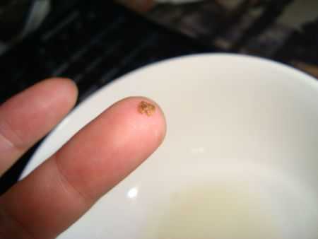 孕期结石(孕期结石疼怎么办) 第2张 孕期结石(孕期结石疼怎么办) 第2张