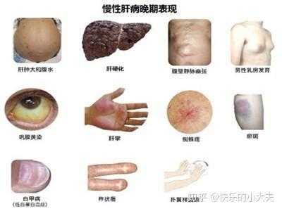 孕期黄疸（孕期黄疸的症状表现）  第1张