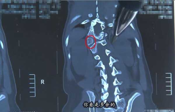 胎儿半椎体主要由什么原因引起,胎儿半椎体畸形图片大全 第2张 胎儿半椎体主要由什么原因引起,胎儿半椎体畸形图片大全 第2张