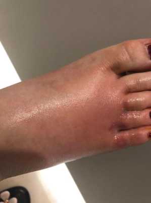 孕期脚气（孕妇得脚气怎么办）  第2张