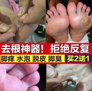 孕期脚气（孕妇得脚气怎么办）  第3张