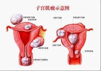 子宫肌瘤会影响胎儿发育吗(怀孕子宫肌瘤会影响胎儿发育吗) 第2张 子宫肌瘤会影响胎儿发育吗(怀孕子宫肌瘤会影响胎儿发育吗) 第2张