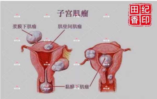 子宫肌瘤会影响胎儿发育吗(怀孕子宫肌瘤会影响胎儿发育吗) 第1张 子宫肌瘤会影响胎儿发育吗(怀孕子宫肌瘤会影响胎儿发育吗) 第1张
