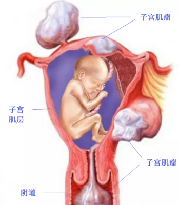 子宫肌瘤会影响胎儿发育吗(怀孕子宫肌瘤会影响胎儿发育吗) 第3张 子宫肌瘤会影响胎儿发育吗(怀孕子宫肌瘤会影响胎儿发育吗) 第3张