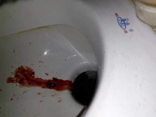孕期出血怎么办(孕妇大便出血怎么办) 第3张 孕期出血怎么办(孕妇大便出血怎么办) 第3张