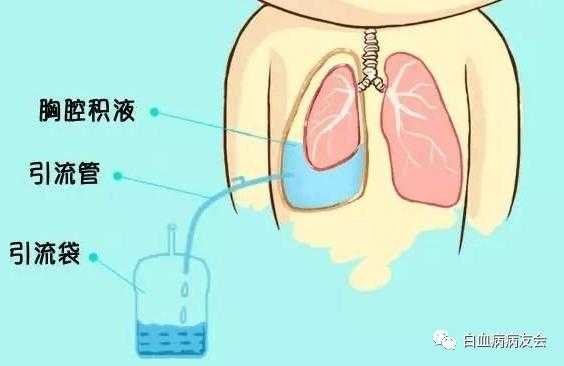 胎儿胸腔积液还能要吗（胎儿胸腔积液还能要吗）  第1张