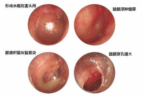 中耳炎会导致耳聋吗,孕妇中耳炎胎儿会聋吗怎么治疗 第1张 中耳炎会导致耳聋吗,孕妇中耳炎胎儿会聋吗怎么治疗 第1张