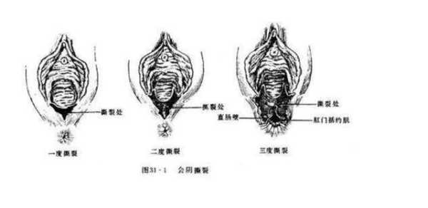 顺产胎儿几斤最合适(顺产下面很大一个洞怎样修复) 第2张 顺产胎儿几斤最合适(顺产下面很大一个洞怎样修复) 第2张
