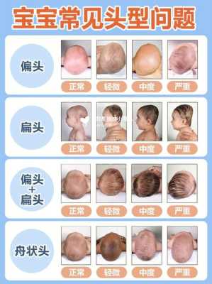脑袋扁怎么变圆,胎儿头扁属于畸形吗图片  第3张