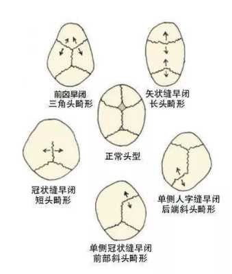 脑袋扁怎么变圆,胎儿头扁属于畸形吗图片  第2张