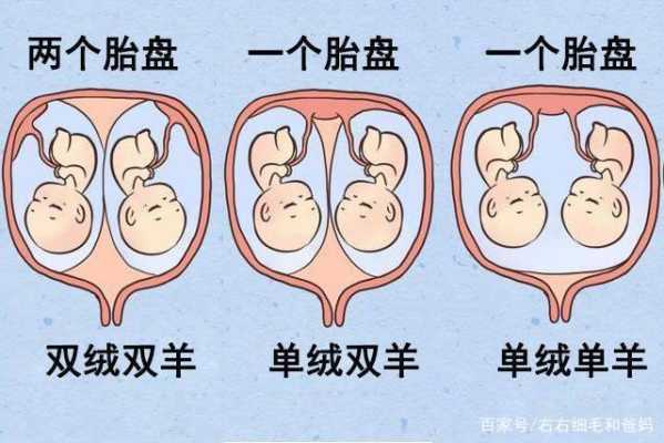 两个胎儿共用一个胎盘(单担和孖担区别) 第2张 两个胎儿共用一个胎盘(单担和孖担区别) 第2张