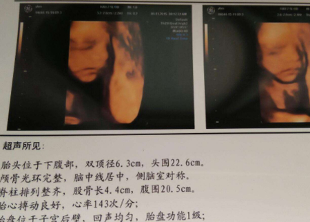 b超mi和tib是什么意思?怀孕了还要做啥检查,孕期b超检查字母代表 第2张 b超mi和tib是什么意思?怀孕了还要做啥检查,孕期b超检查字母代表 第2张
