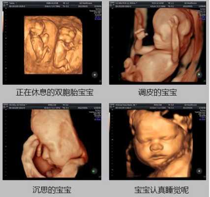胎儿大排畸和四维的区别(胎儿大排畸和四维的区别是什么) 第1张 胎儿大排畸和四维的区别(胎儿大排畸和四维的区别是什么) 第1张