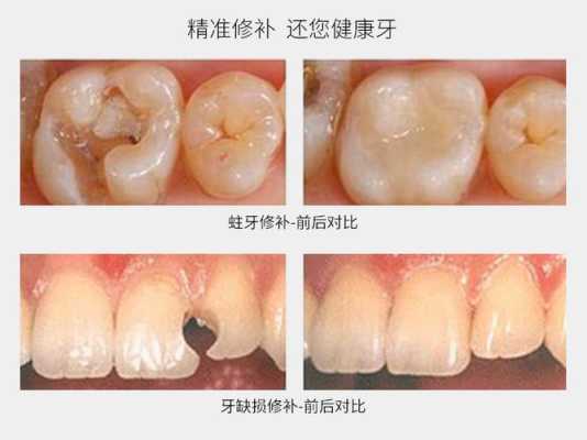 孕期补牙(怀孕能补牙吗) 第1张 孕期补牙(怀孕能补牙吗) 第1张