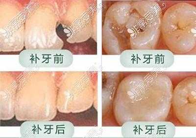 孕期补牙(怀孕能补牙吗) 第2张 孕期补牙(怀孕能补牙吗) 第2张