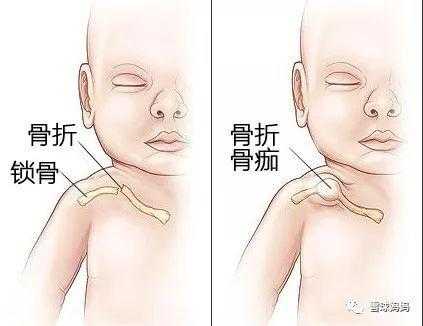 受到挤压胎儿会骨折吗(受到挤压胎儿会骨折吗) 第2张 受到挤压胎儿会骨折吗(受到挤压胎儿会骨折吗) 第2张