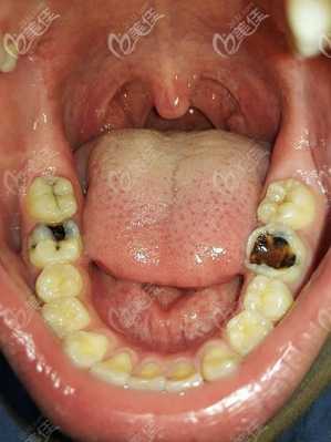 孕期蛀牙(孕期蛀牙疼痛难忍怎么缓解) 第2张 孕期蛀牙(孕期蛀牙疼痛难忍怎么缓解) 第2张