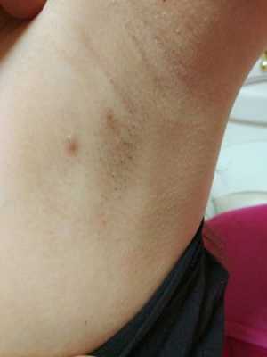 怀孕副乳会变大吗,孕期副乳上长了个小乳头 第1张 怀孕副乳会变大吗,孕期副乳上长了个小乳头 第1张