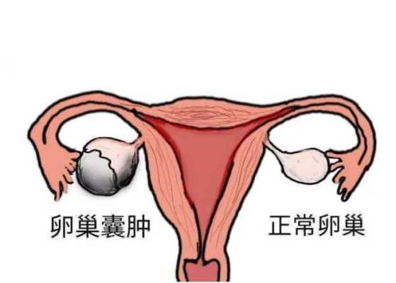 孕期卵巢囊肿(孕期卵巢囊肿影响胎儿吗) 第2张 孕期卵巢囊肿(孕期卵巢囊肿影响胎儿吗) 第2张