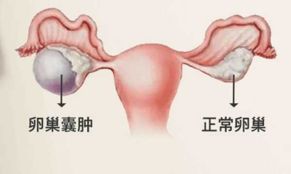 孕期卵巢囊肿(孕期卵巢囊肿影响胎儿吗) 第1张 孕期卵巢囊肿(孕期卵巢囊肿影响胎儿吗) 第1张