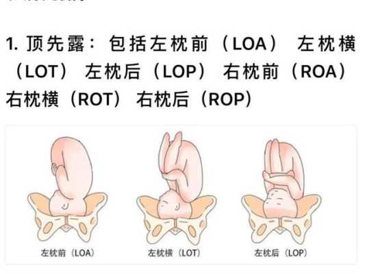 胎儿左枕横位男孩多(胎位LOT是什么意思啊,胎位正吗?能否顺产) 第2张 胎儿左枕横位男孩多(胎位LOT是什么意思啊,胎位正吗?能否顺产) 第2张