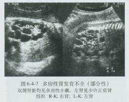 胎儿多囊肾是什么原因造成的(胎儿多囊肾会不会慢慢变好) 第1张 胎儿多囊肾是什么原因造成的(胎儿多囊肾会不会慢慢变好) 第1张