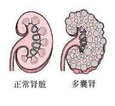 胎儿多囊肾是什么原因造成的(胎儿多囊肾会不会慢慢变好) 第2张 胎儿多囊肾是什么原因造成的(胎儿多囊肾会不会慢慢变好) 第2张